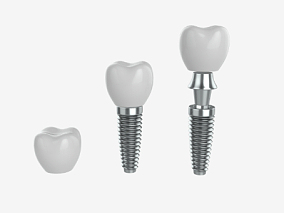 种牙 镶牙 假牙 镶嵌牙齿 牙齿修复 种植牙齿 种牙道具 牙种植体 陶瓷牙