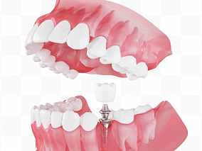 3D立体牙龈种植牙全景模型元素