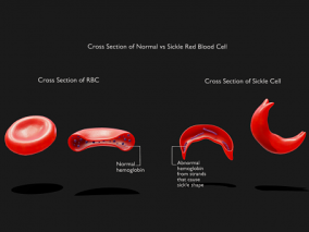 红细胞 镰状红细胞 红细胞横截面 PBR材质 生物结构